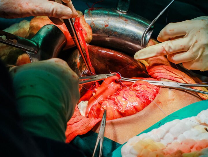 Emergency vs Planned Liver Transplant