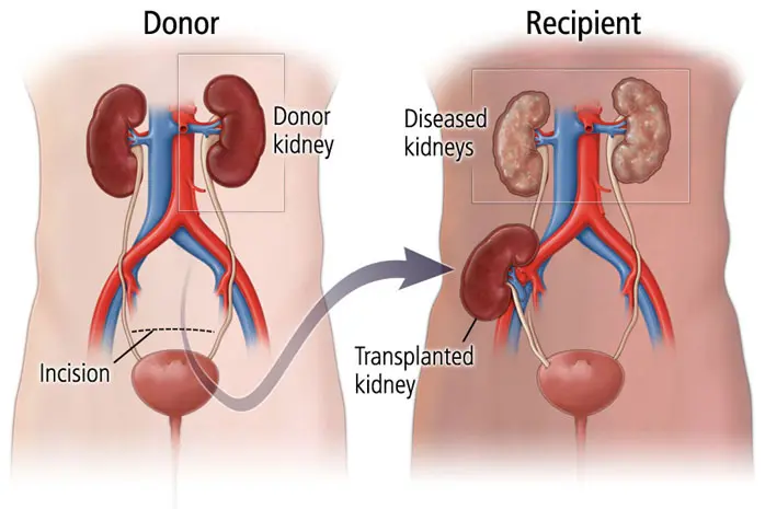 Kidney-Transplantation-Donor Kidney Transplantation Donor