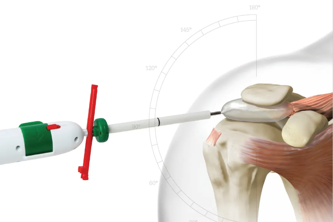 Arthroscopic subacromial balloon implantation
