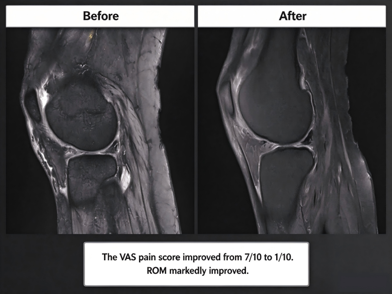Knee MRI before and after stem cell therapy