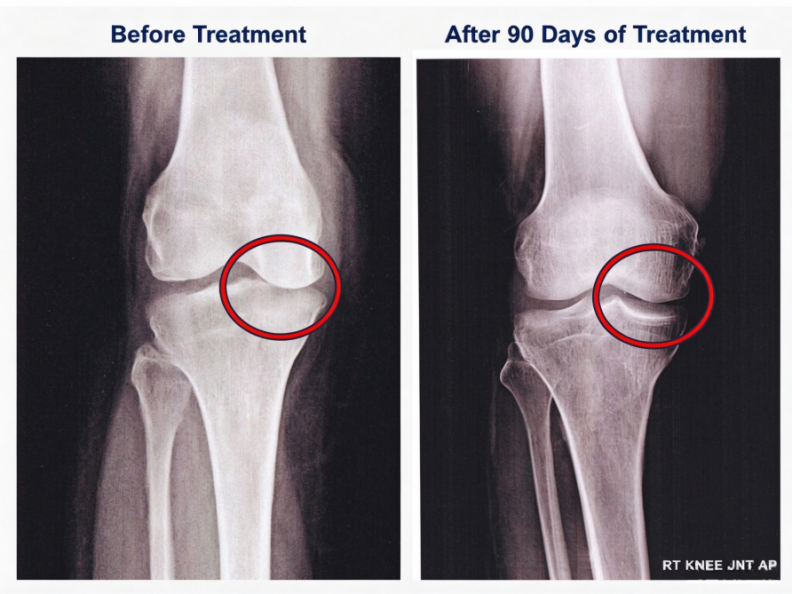 Knee X-ray before and 90 days after regenerative injection